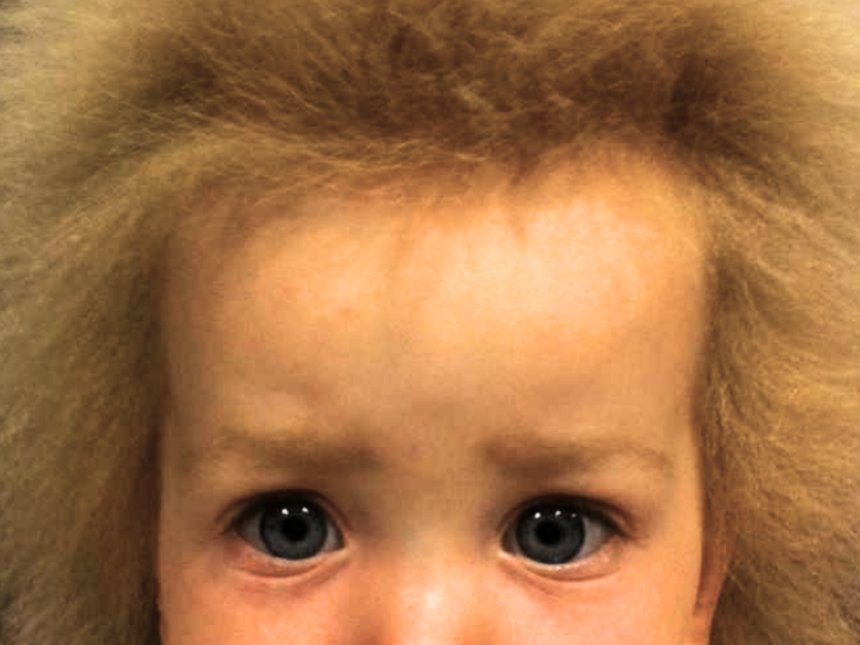 Girl with Uncombable Hair Syndrome staring into camera